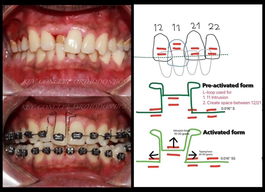 L Shap Loop L - loop การดัดแปลงเพื่อนำไปใช้ - Keyconcept Ortho